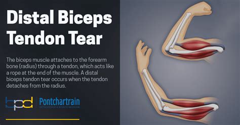 As the damage progresses, the <b>tendon</b> can completely <b>tear</b>, sometimes when lifting a heavy object. . Partial distal bicep tendon tear recovery time